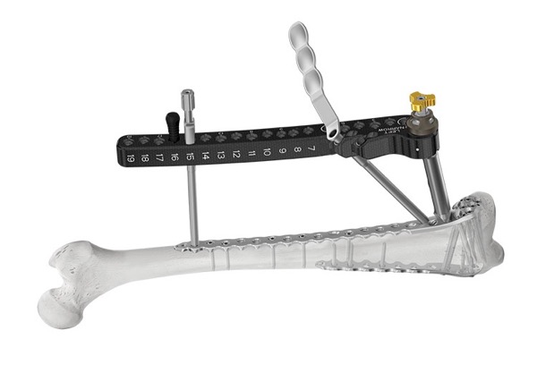 ANTHEM Distal Femur Fracture System